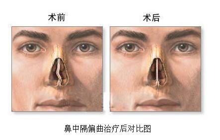 鼻中隔偏曲的手术视频,鼻中隔偏曲手术全过程解析